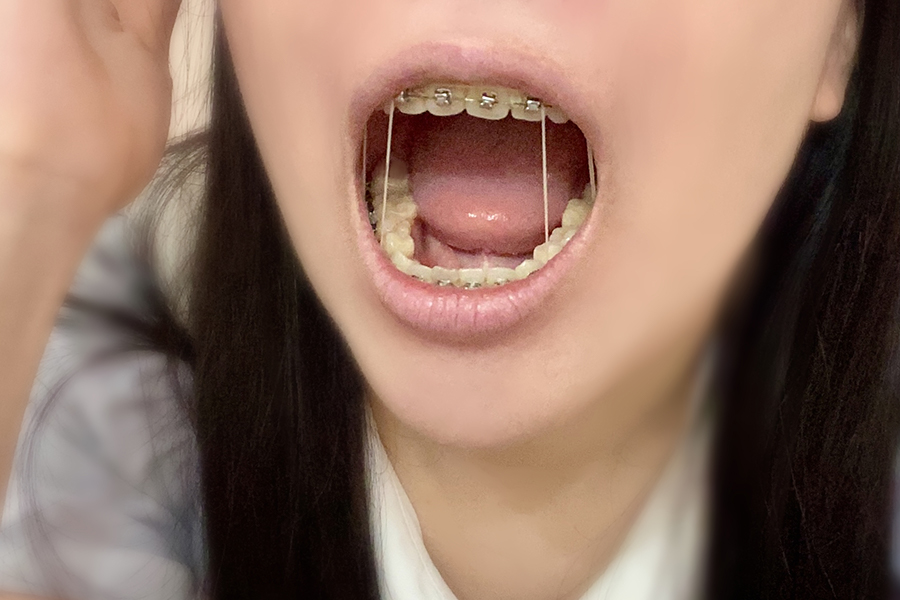 ワイヤー矯正とは